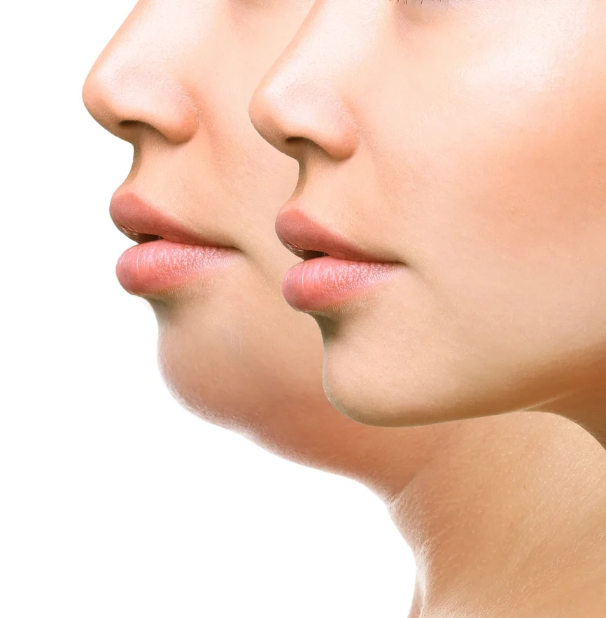 Eliminare bărbie dublă