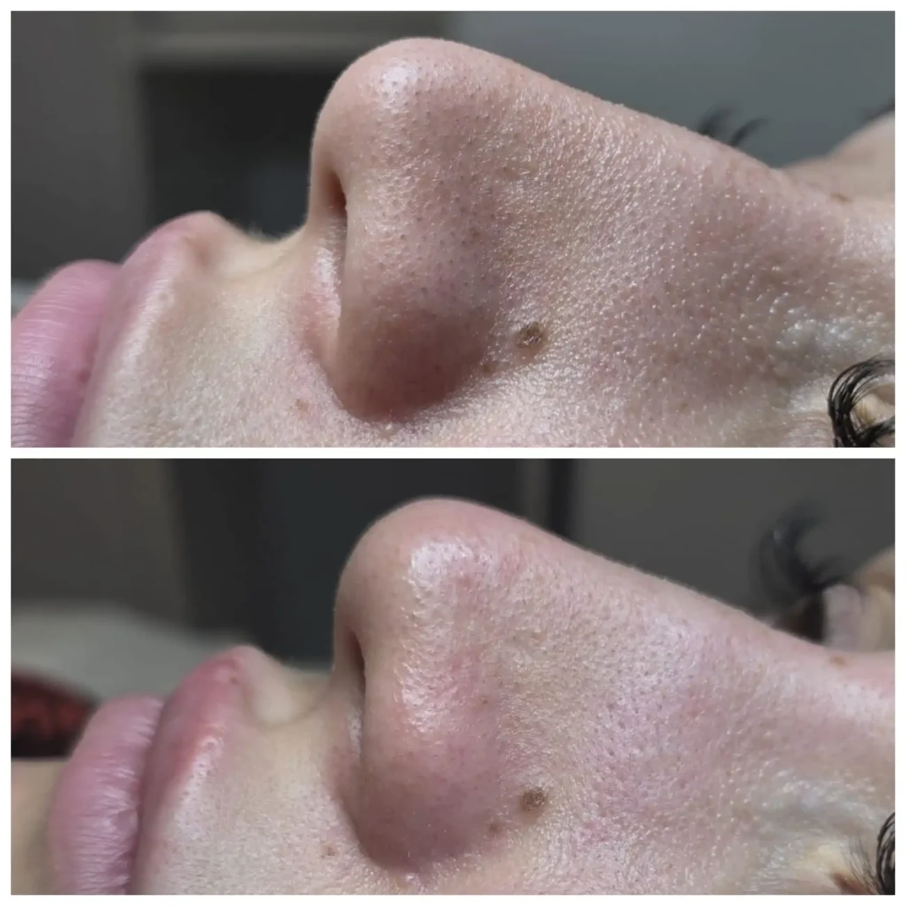 Carbon peeling - Inainte si dupa - Tratament nas