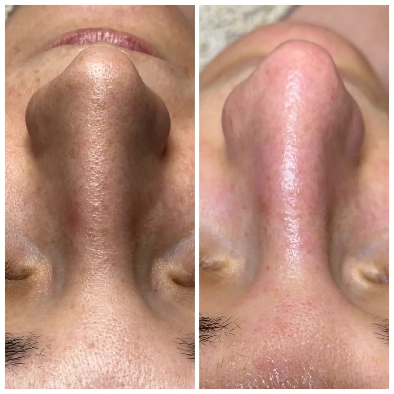 Carbon peeling - Inainte si dupa - Tratament nas - 2