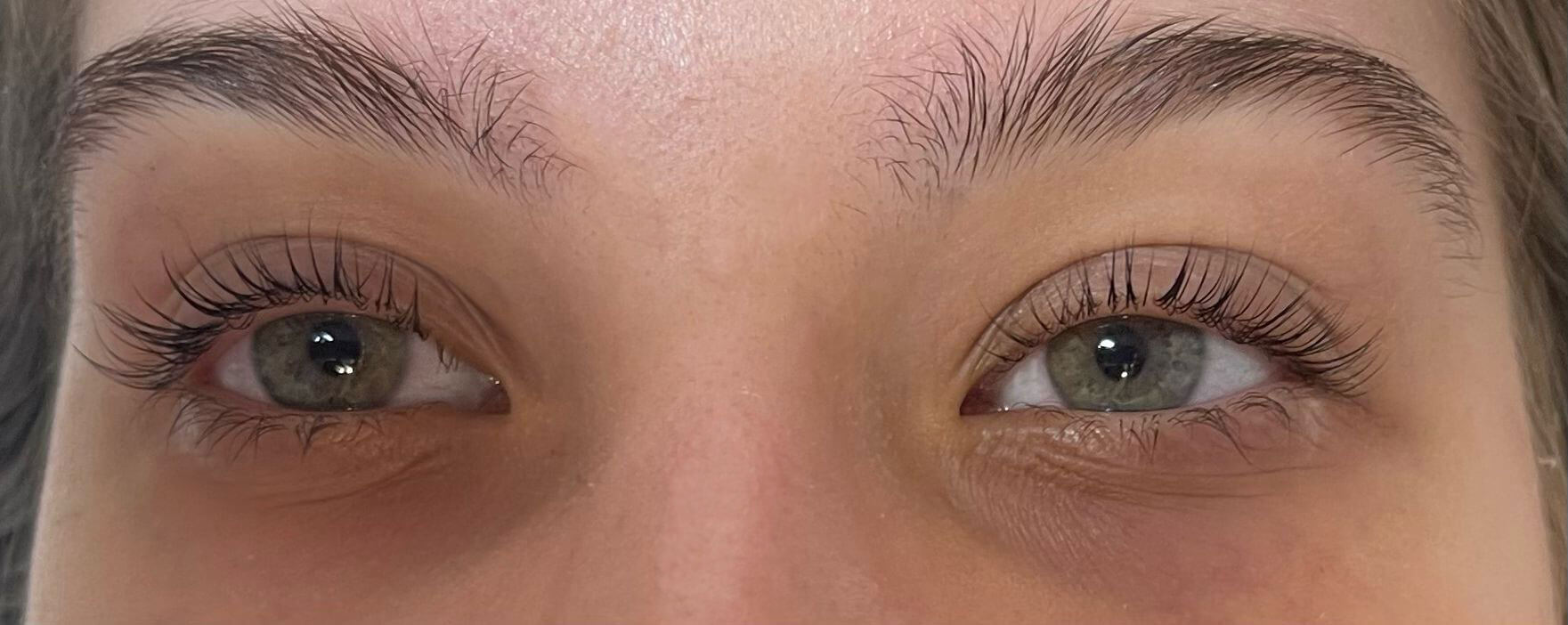 Laminare gene dupa tratament