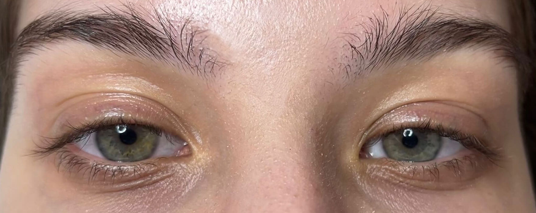 Laminare gene inainte tratament