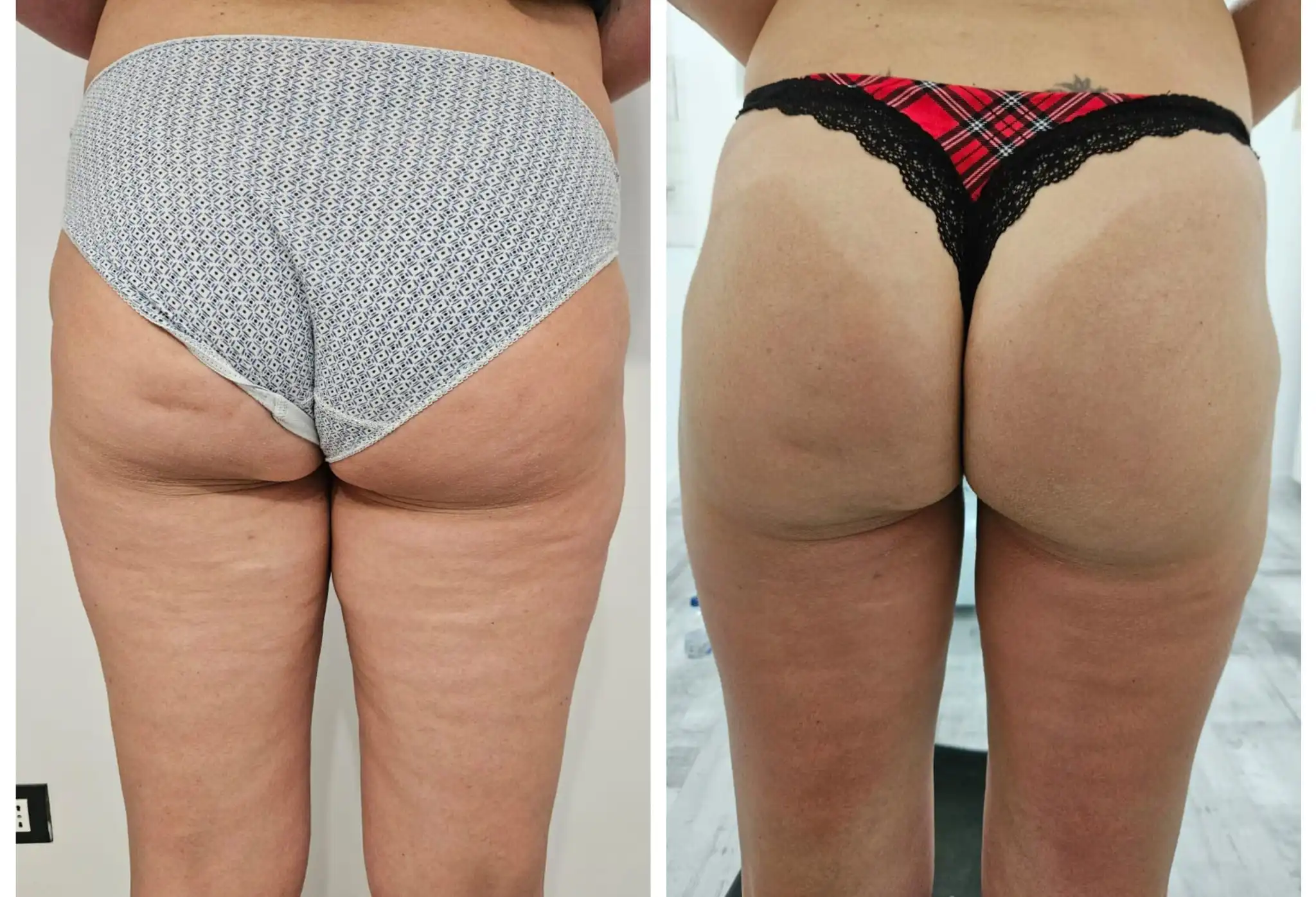 R-FIT - Inainte si dupa - Tratament fese